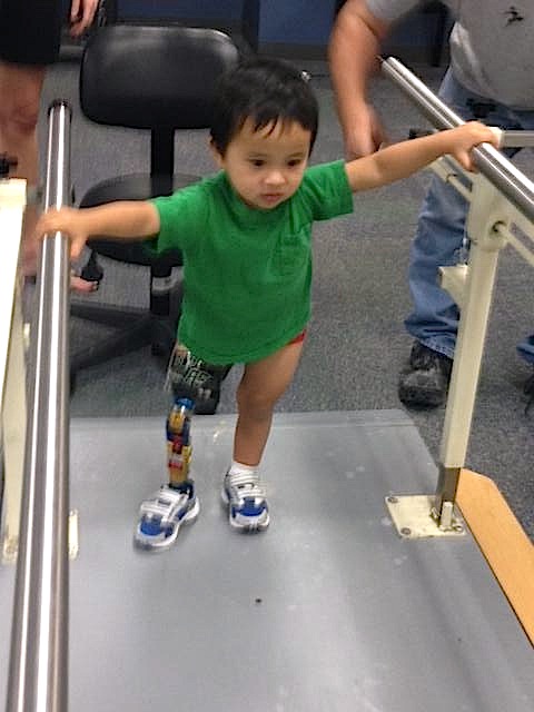 Young child with prosthetic leg using bars to walk