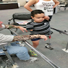 Child Amputee In Physical Therapy