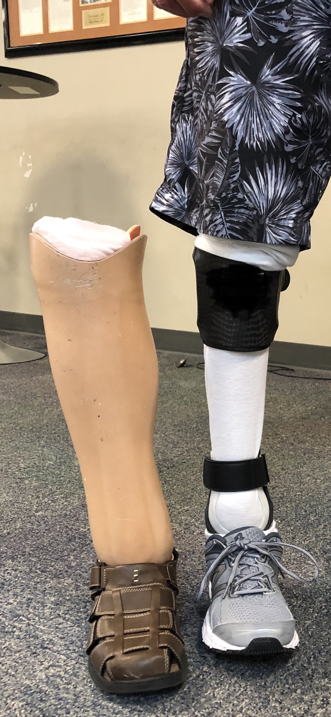 Transtibial Prosthesis - Prosthetic & Orthotic Associates